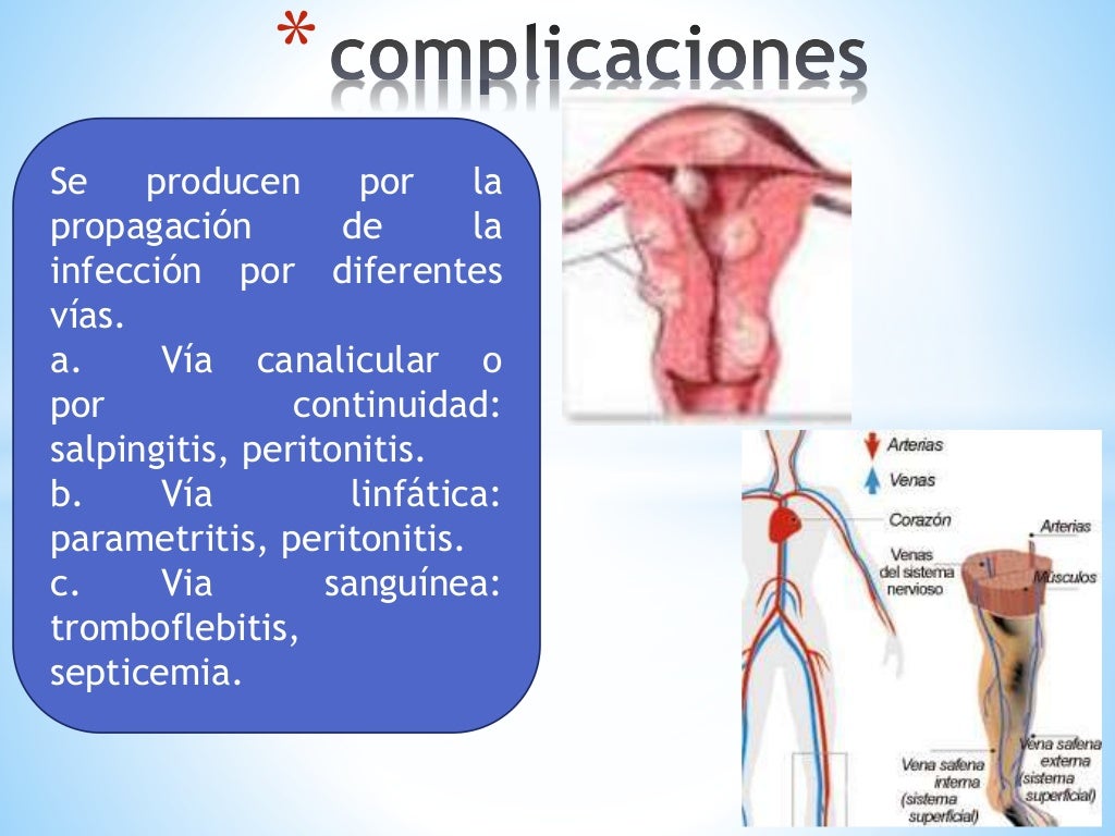 Endometritis puerperal