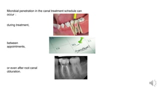 Microbial penetration in the canal treatment schedule can
occur :
during treatment,
between
appointments,
or even after root canal
obturation.
 