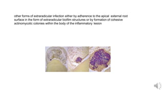other forms of extraradicular infection either by adherence to the apical external root
surface in the form of extraradicular biofilm structures or by formation of cohesive
actinomycotic colonies within the body of the inflammatory lesion
 