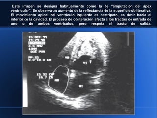 ●
 Esta imagen se designa habitualmente como la de "amputación del ápex
ventricular". Se observa un aumento de la reflectancia de la superficie obliterativa.
El movimiento apical del ventrículo izquierdo es centrípeto, es decir hacia el
interior de la cavidad. El proceso de obliteración afecta a los tractos de entrada de
uno o de ambos ventrículos, pero respeta el tracto de salida.
 