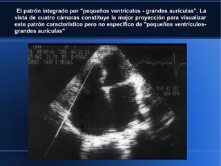 ●
 El patrón integrado por "pequeños ventrículos - grandes aurículas". La
vista de cuatro cámaras constituye la mejor proyección para visualizar
este patrón característico pero no específico de "pequeños ventrículos-
grandes aurículas"
 