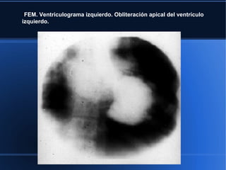●
 FEM. Ventriculograma izquierdo. Obliteración apical del ventrículo
izquierdo.
 