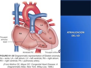 ATRIALIZACION
   DEL VD
 