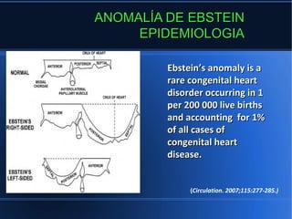 ANOMALÍA DE EBSTEIN
     EPIDEMIOLOGIA

         Ebstein’s anomaly is a
         rare congenital heart
         disorder occurring in 1
         per 200 000 live births
         and accounting for 1%
         of all cases of
         congenital heart
         disease.


              (Circulation. 2007;115:277-285.)
 