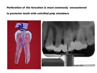 Perforation of the furcation is most commonly encountered

in posterior teeth with calcified pulp chambers

 