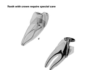Tooth with crown require special care

 