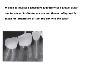 In case of calcified chambers or teeth with a crown, a bur
can be placed inside the access and then a radiograph is
taken for orientation of the the bur with the canal

 