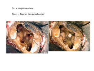 Furcation perforations:
Direct : floor of the pulp chamber

 