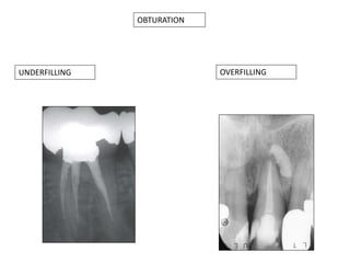 OBTURATION

UNDERFILLING

OVERFILLING

 