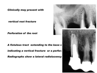 Clinically may present with

vertical root fracture

Perforation of the root

A fistulous tract extending to the base of the post
indicating a vertical fracture or a perforation site
Radiographs show a lateral radiolucency

 