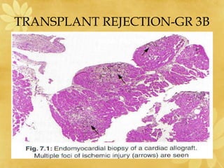 TRANSPLANT REJECTION-GR 3B
 
