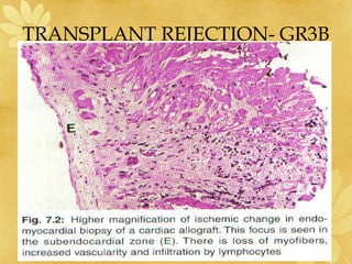 TRANSPLANT REJECTION- GR3B
 