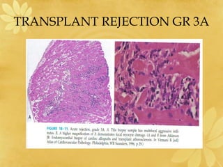 TRANSPLANT REJECTION GR 3A
 