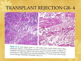 TRANSPLANT REJECTION GR- 4
 
