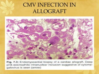 CMV INFECTION IN
ALLOGRAFT
 