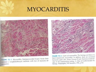MYOCARDITIS
 
