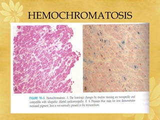HEMOCHROMATOSIS
 