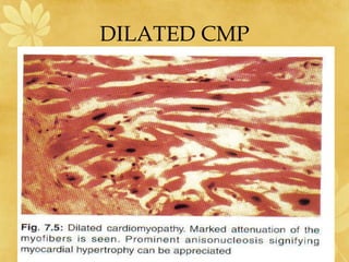 DILATED CMP
 