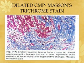 DILATED CMP- MASSON’S
TRICHROME STAIN
 