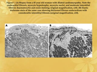 Figure 1 (A) Biopsy from a 45 year old woman with dilated cardiomyopathy. Note the
endocardial fibrosis, myocyte hypertrophy, myocyte nuclei, and moderate interstitial
fibrosis (haematoxylin and eosin staining; original magnification, x10). (B) Elastic
trichrome stain of the same case showing thickened fibrous endocardium with
considerable interstitial fibrosis (original magnification, x10).
 