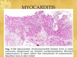 MYOCARDITIS
 
