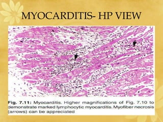 MYOCARDITIS- HP VIEW
 