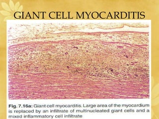 GIANT CELL MYOCARDITIS
 