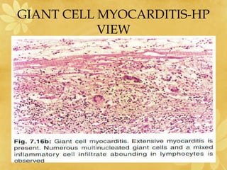 GIANT CELL MYOCARDITIS-HP
VIEW
 