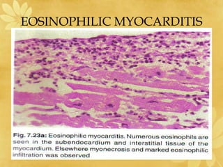 EOSINOPHILIC MYOCARDITIS
 