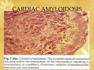 CARDIAC AMYLOIDOSIS
 