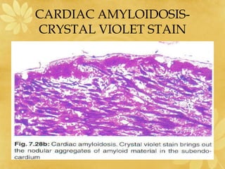 CARDIAC AMYLOIDOSIS-
CRYSTAL VIOLET STAIN
 