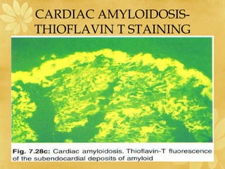 CARDIAC AMYLOIDOSIS-
THIOFLAVIN T STAINING
 