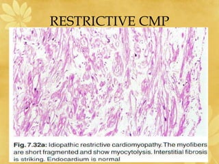 RESTRICTIVE CMP
 