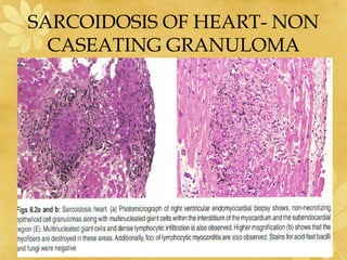 SARCOIDOSIS OF HEART- NON
CASEATING GRANULOMA
 