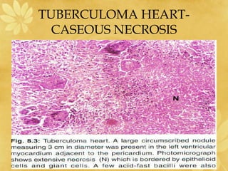 TUBERCULOMA HEART-
CASEOUS NECROSIS
 