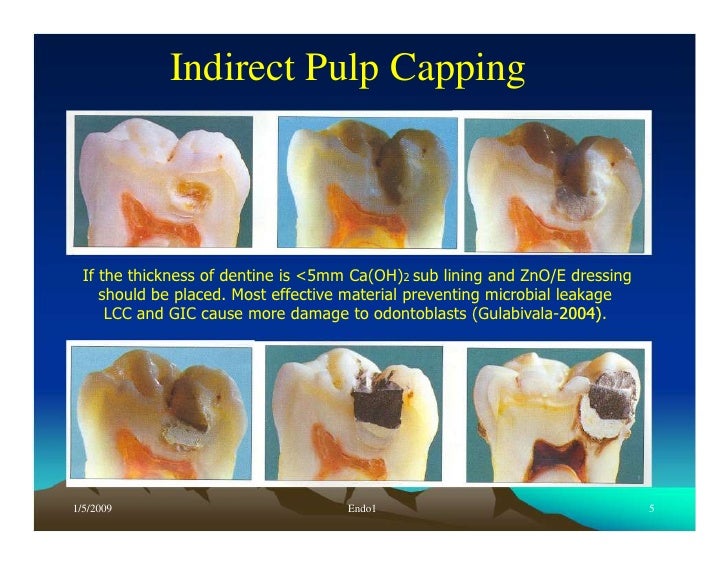 Endo note 1 definition and history