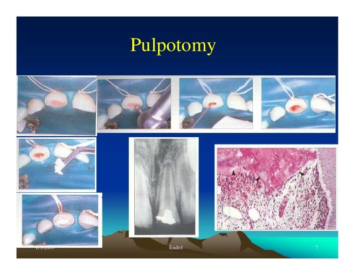Endo note 1 definition and history