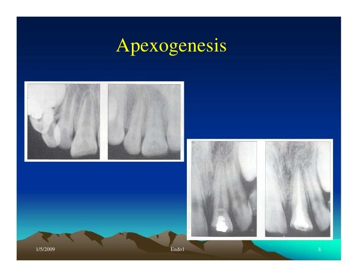 Endo note 1 definition and history