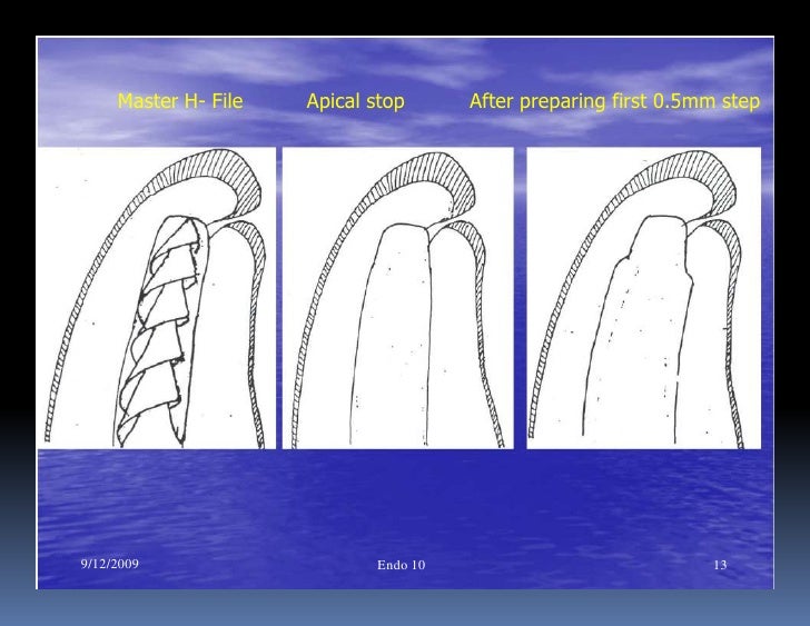 Endo note 10 preparation of straight canal