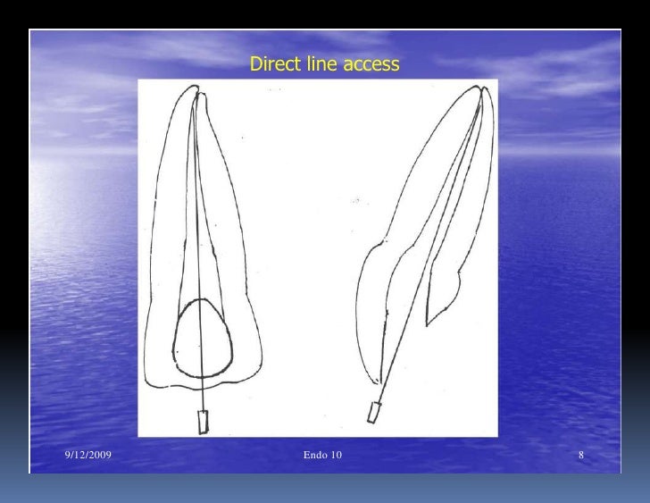 Endo note 10 preparation of straight canal