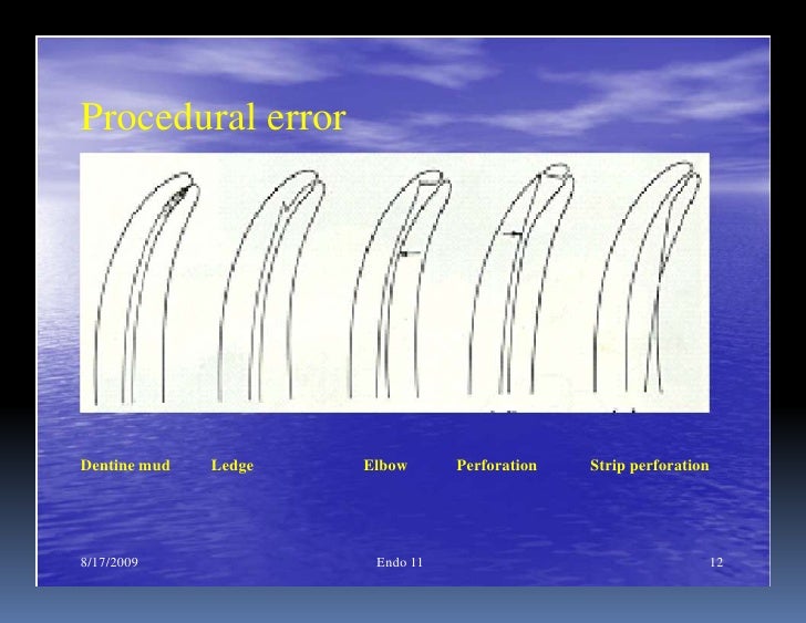 Endo note 11 peparation of curved root canal