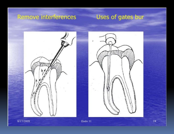 Endo note 11 peparation of curved root canal