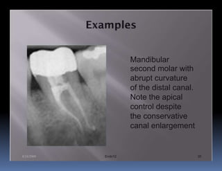 Mandibular
                     second molar with
                     abrupt curvature
                     of the distal canal.
                     Note the apical
                     control despite
                     the conservative
                     canal enlargement


8/24/2009   Endo12                          35
 