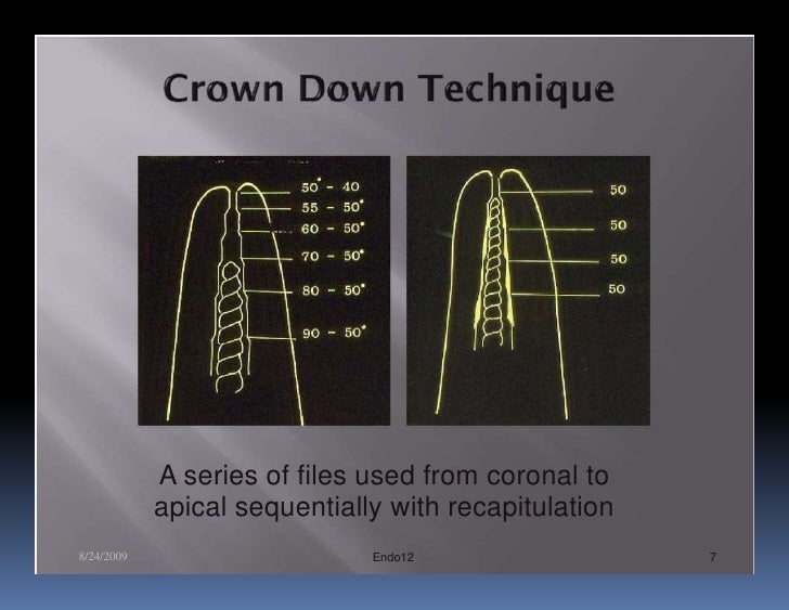 Endo note 12 rotary technique