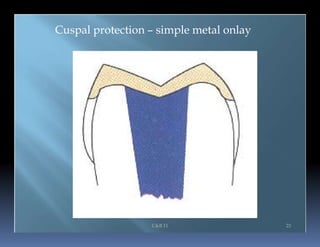 Cuspal Protection Endo note 16 restoration of root filled | PPTX