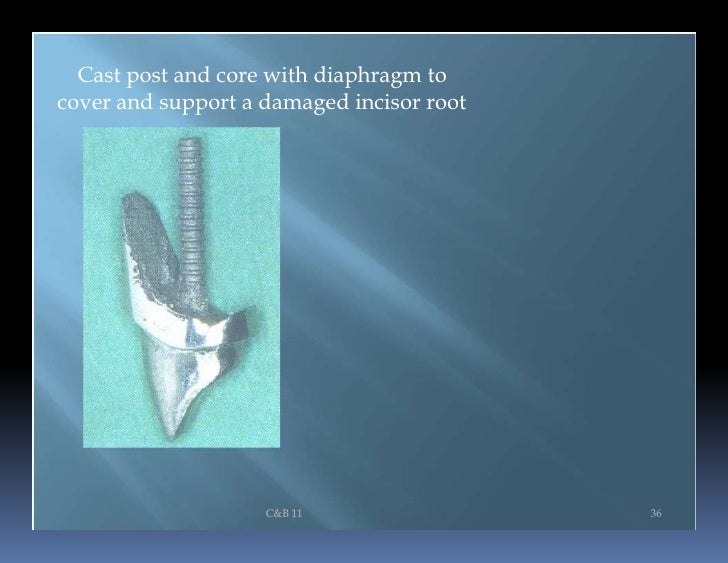 cast post and core