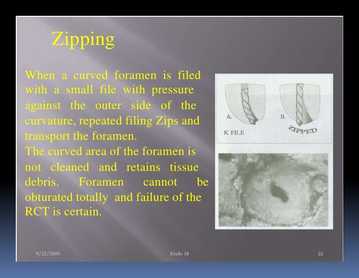 Endo note 18 ledge formation