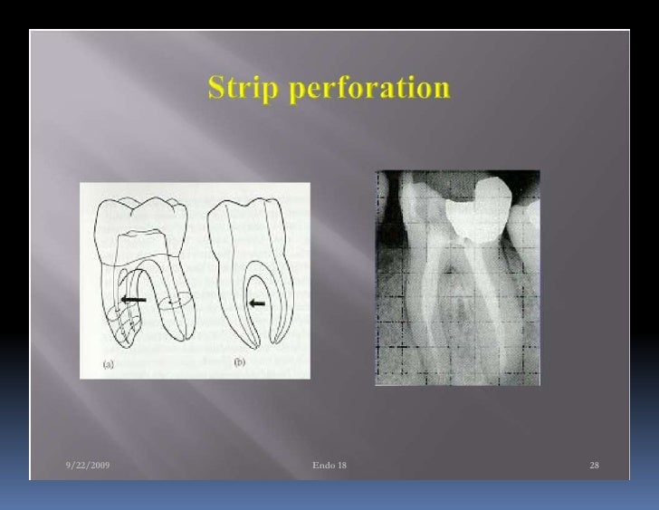 Endo note 18 ledge formation