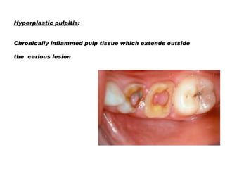 INTERNAL RESORPTION:
Mostly asymptomatic , but the patient may complain
of vague, dull pain

Clinically seen as the pink t...