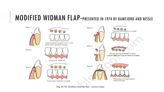 MODIFIED WIDMAN FLAP-PRESENTED IN 1974 BY RAMFJORD AND NISSLE
 